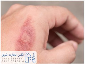 آب اکسیژنه در سوختگی ها