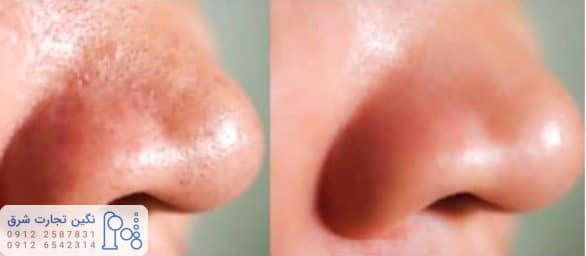 کاربرد آب اکسیژنه در لکه های پوستی